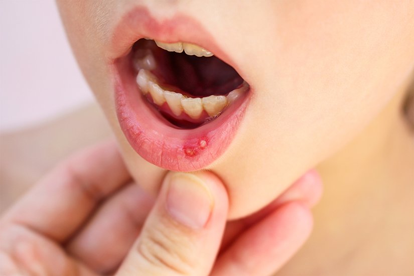 About canker sores beyond the aesthetic side