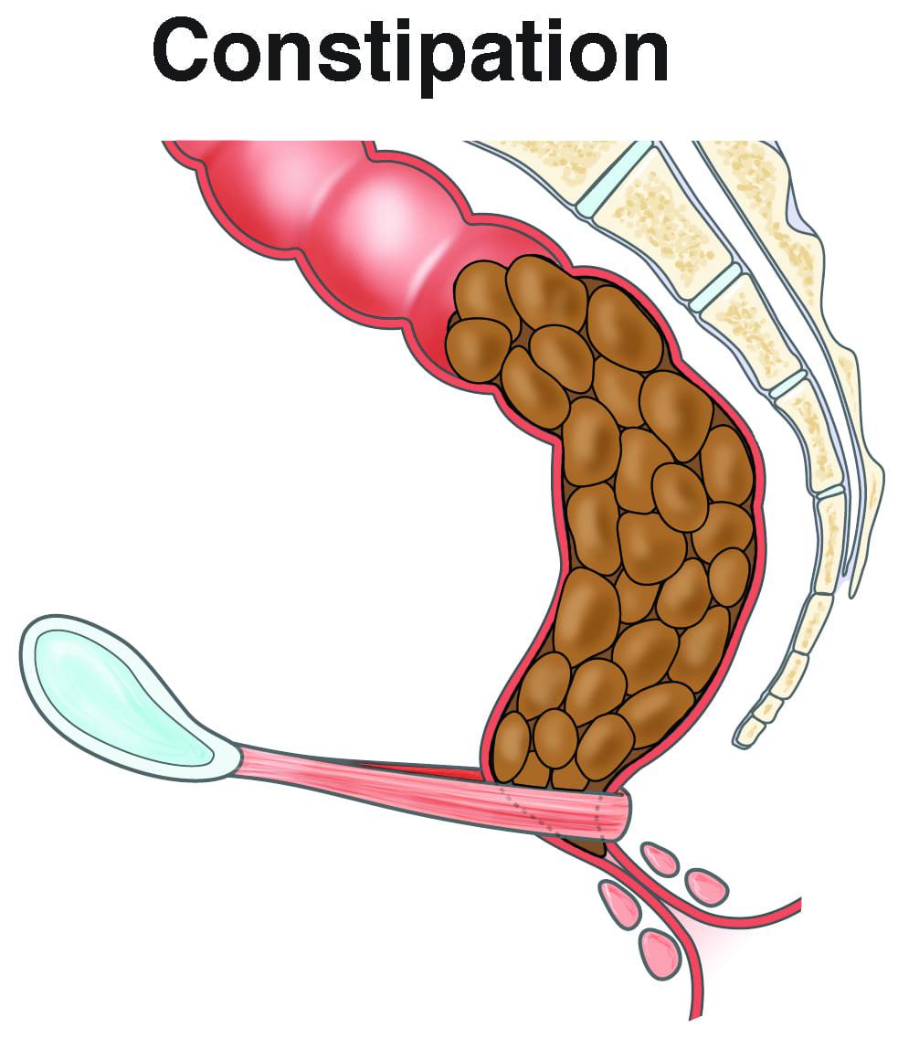 Constipation in adults: causes, investigations, treatment