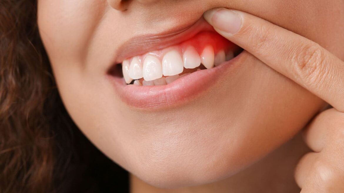 Gingivitis: causes, symptoms, diagnosis and treatment