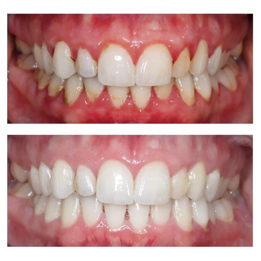 Gum disease