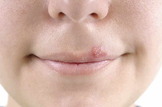 Oral herpes: why does it occur and how long does it take to cure?